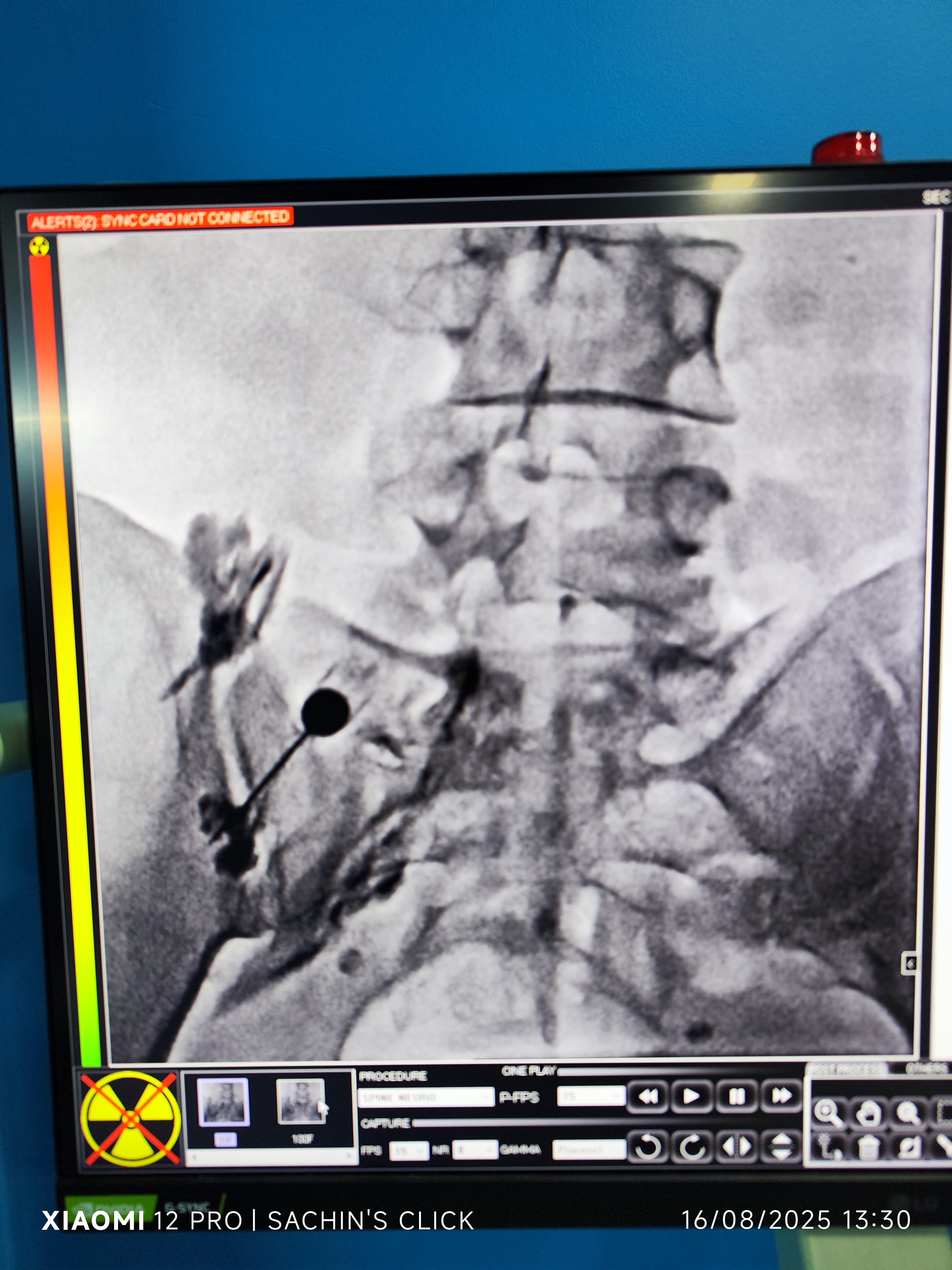 Fluoroscopy guided lumbar spine