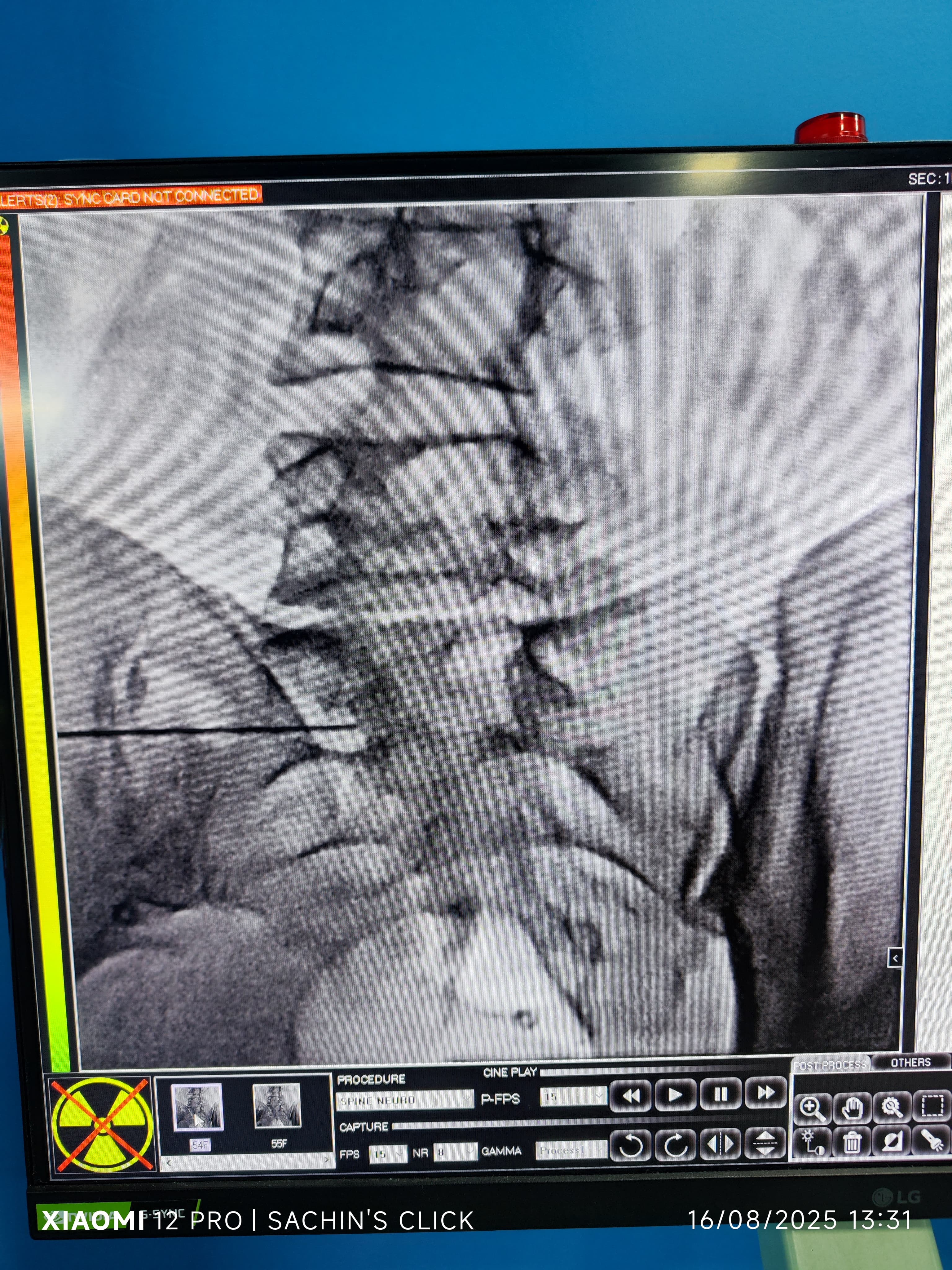 Fluoroscopy (X-ray)