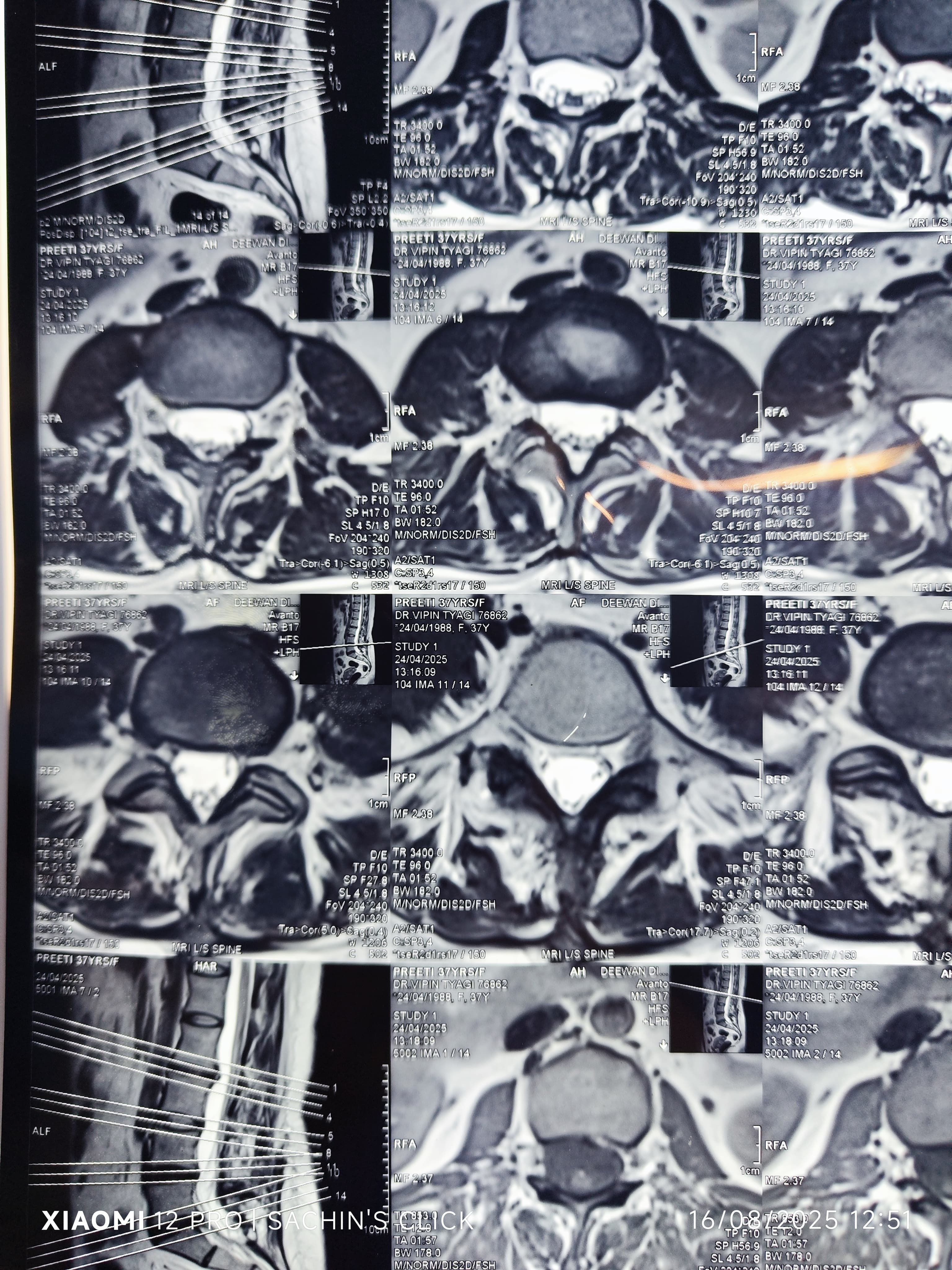 Lumbar Spine