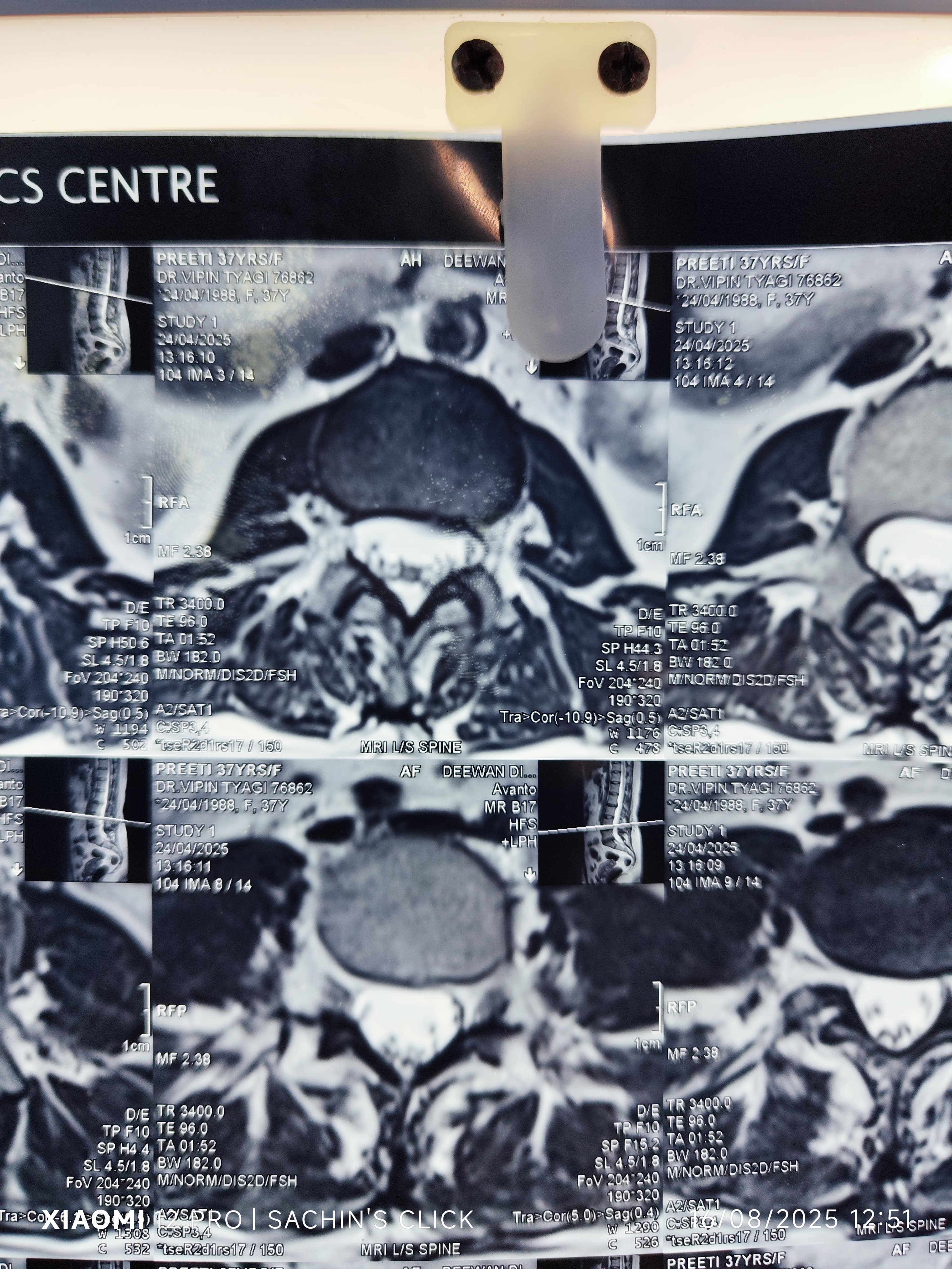 Mri Of Lumbar Spine