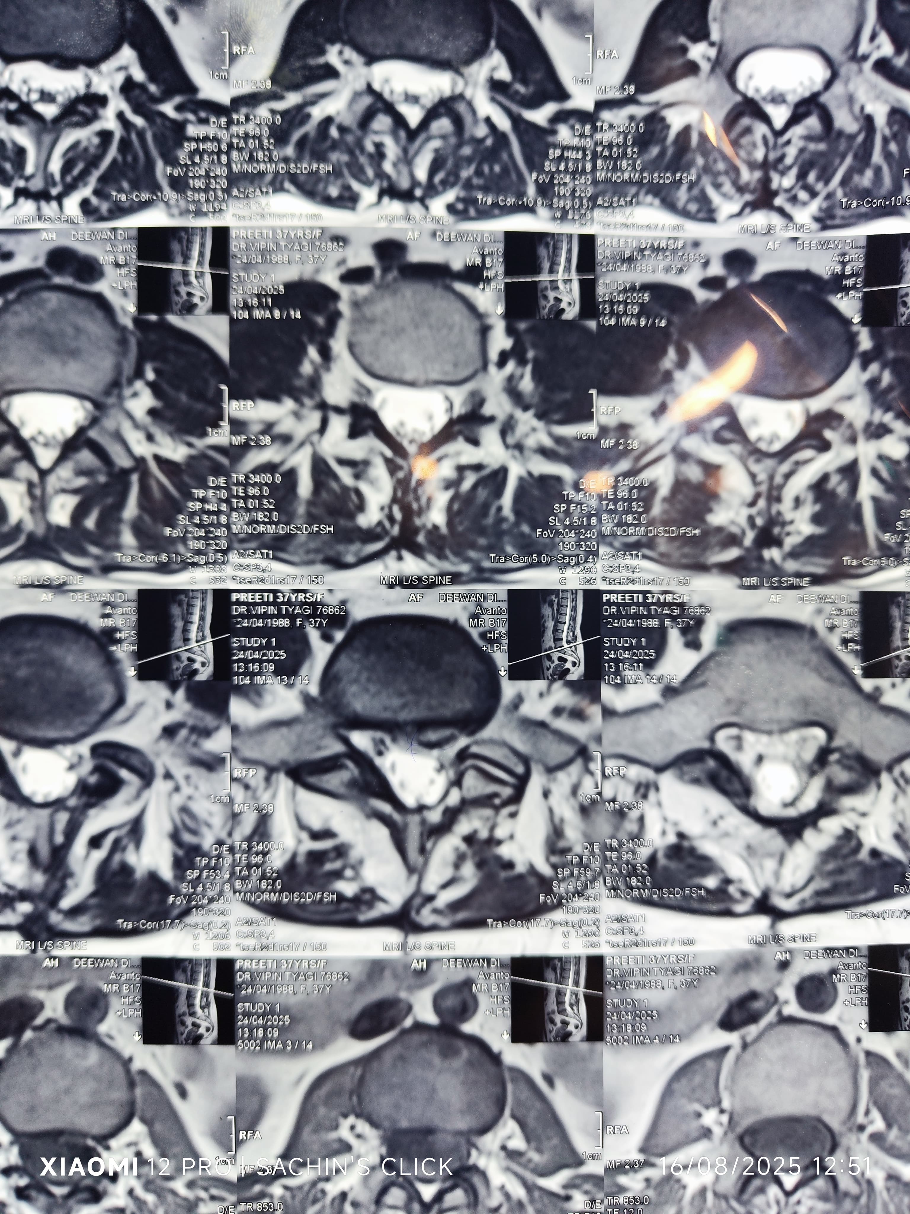 MRi Lumbar Section axial section